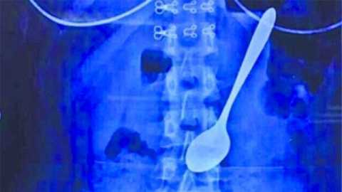 Nữ sinh ăn kem nuốt luôn thìa 14cm vào bụng