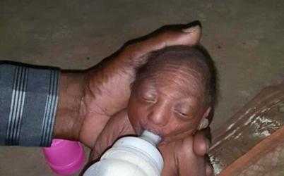Xót xa bé 2 tuần tuổi bị bố mẹ bỏ rơi vì hình dạng kỳ dị