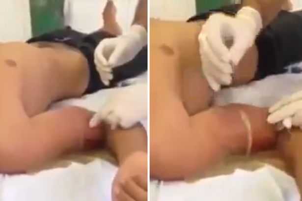 Clip: Lãnh họa khủng khiếp sau khi tiêm dầu dưỡng ‘thổi phồng’ bắp tay
