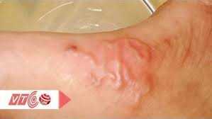 Cách phòng và điều trị bệnh sán lợn