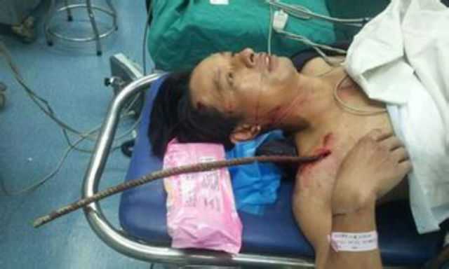 Thoát chết may mắn dù bị thanh thép đâm xuyên người