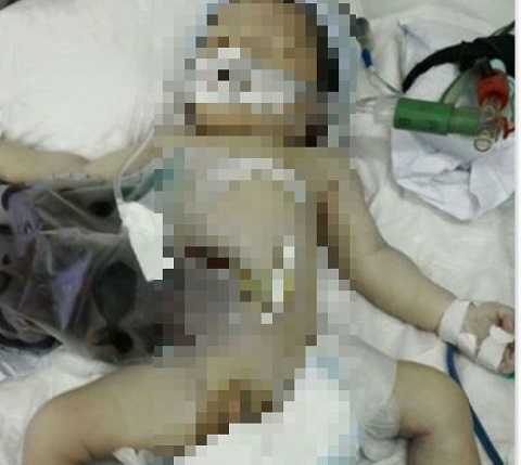 Có phải bác sỹ tuột tay làm bé sơ sinh bị lòi ruột và tử vong?