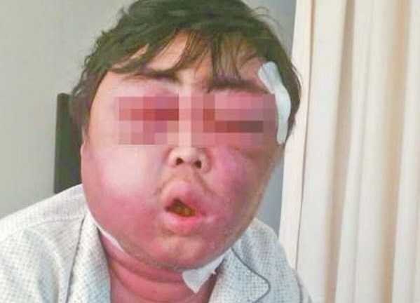 Người đàn ông bị muỗi quái ác đốt mặt sưng như quả bóng