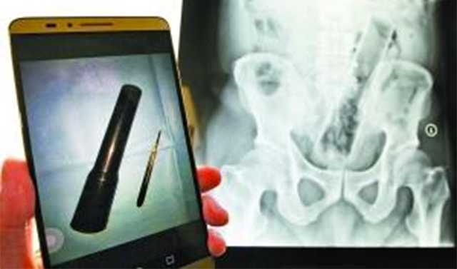 Xi lanh dài bằng cái thước trong trực tràng: Bệnh nhân kiên quyết giấu nhẹm