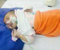 Cảnh báo trẻ ho gà tăng đột biến