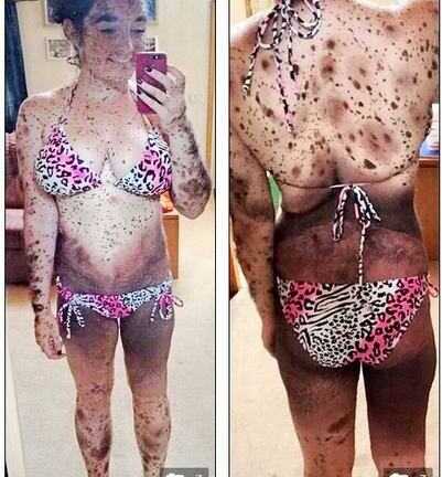 Bệnh lạ khiến thiếu nữ có làn da như da báo