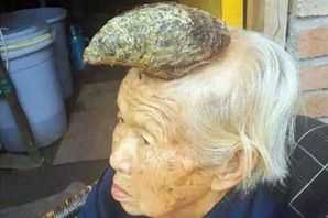 Video: Kỳ lạ cụ bà 87 tuổi mọc sừng dài 13cm trên đầu