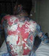 Ngộ độc do tự ý sử dụng thuốc Đông y