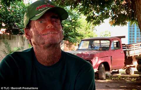 Khủng khiếp người dân ở 'ngôi làng ma' cứ gặp nắng là mặt biến dạng