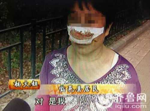 Trung Quốc: Không nghe điện thoại, vợ bị chồng cắn đứt mũi