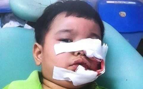 Bé trai 3 tuổi bị chó nhà cắn vào mặt phải khâu 200 mũi