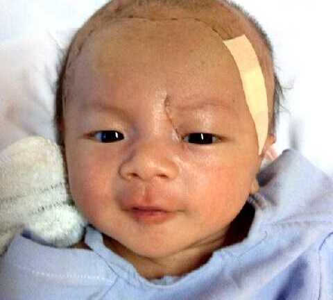 Tin mới nhất về bé trai bị đâm xuyên não