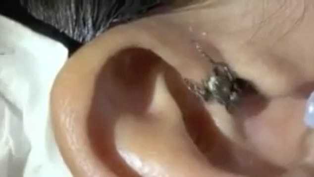 Rùng mình xem cảnh nhện chui ra khỏi tai người