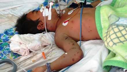 Bác sỹ Bạch Mai đang khẩn trương cấp cứu 50 bệnh nhi bị ong đốt