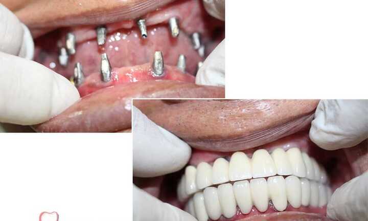 Dental Implant - Phương pháp trồng răng giả hiện đại