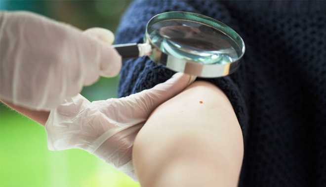 Nếu có hơn 11 nốt ruồi trên tay, có thể bạn đã bị ung thư da