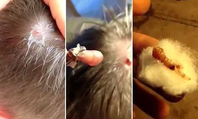 Video: Kinh hãi cảnh gắp ruồi trâu làm ổ 1 tháng trên đầu người đàn ông