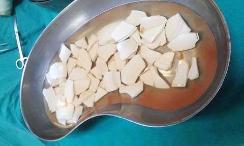 Gắp 59 mảnh bát vỡ trong bụng bệnh nhân