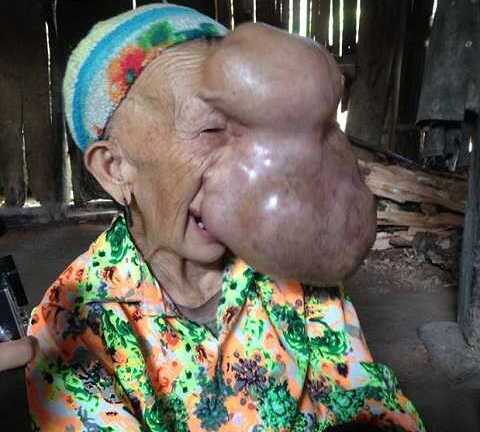 Xin cứu người đàn bà có khối u trên mặt căng như quả bóng chực nổ tung