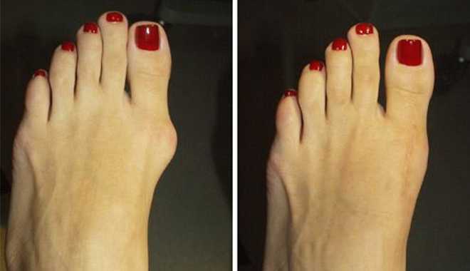 Loại bỏ u biến dạng ở khớp ngón chân cái