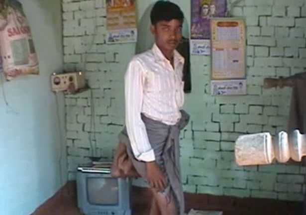 Video: Chàng trai mang danh 'quỷ dữ' với 2 chân mọc trên lưng