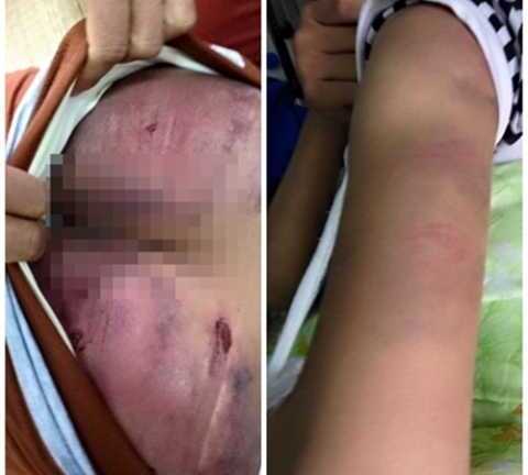 Người cha nhẫn tâm đánh con gái ruột bầm dập khắp người
