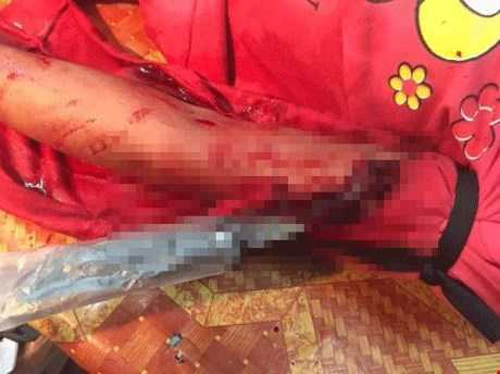 Bé gái 12 tuổi bị kẻ bịt mặt găm dao vào cánh tay đêm Noel