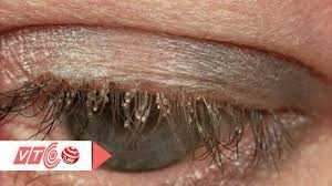 Clip: Rợn người cảnh hàng trăm con rận 'định cư' trên lông mi bé trai