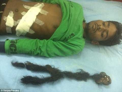 Bào thai ký sinh trong bụng có tóc dài 2 m