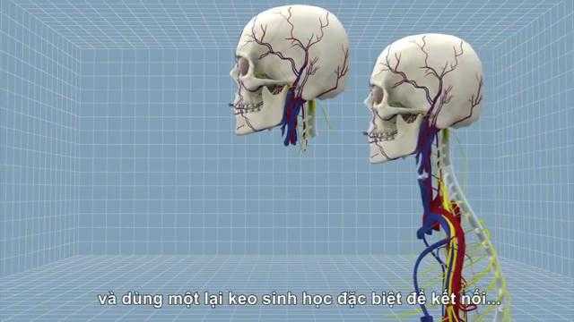 Clip 3D mô phỏng chi tiết quá trình cấy ghép đầu người