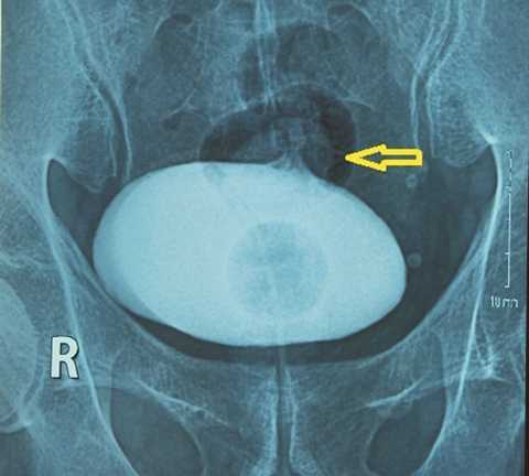 Bệnh lạ gì khiến bệnh nhân ăn gì tiểu ra cái ấy?