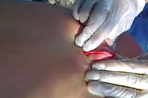 Clip: Mụn khổng lồ tuôn mủ vàng như suối trên lưng người đàn ông