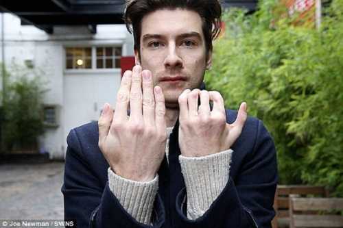 Cắt ngón chân ghép lên ngón tay để nuôi mộng làm diễn viên nổi tiếng