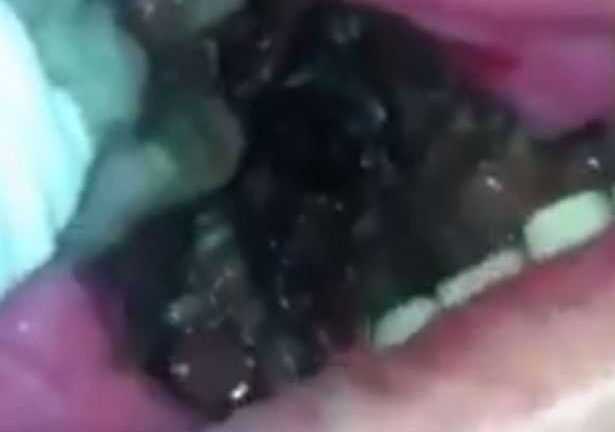 Clip: Khiếp đảm thứ đen sì ‘lúc nhúc’ trong miệng người đàn ông