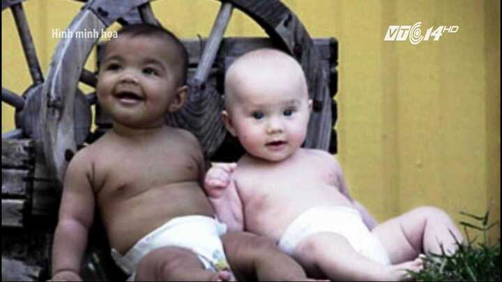 Cặp sinh đôi khác cha hy hữu tại Hòa Bình