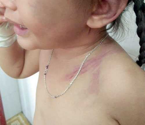 Đau xót nhìn bé gái bị cha dượng đánh bầm tím khắp người vì bênh mẹ
