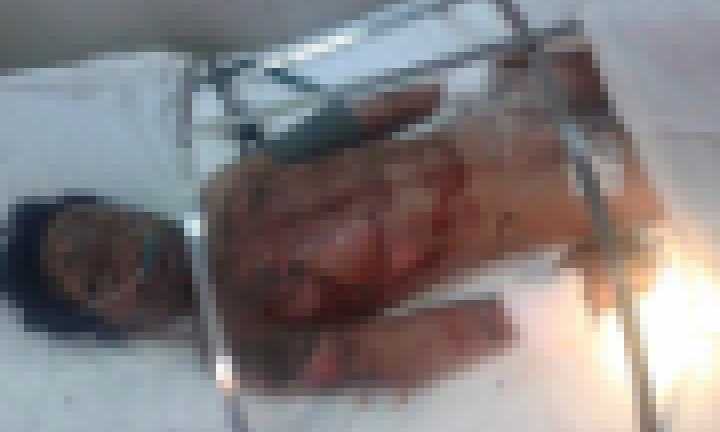 Nướng sắn bằng xăng, bé trai bỏng nặng toàn thân