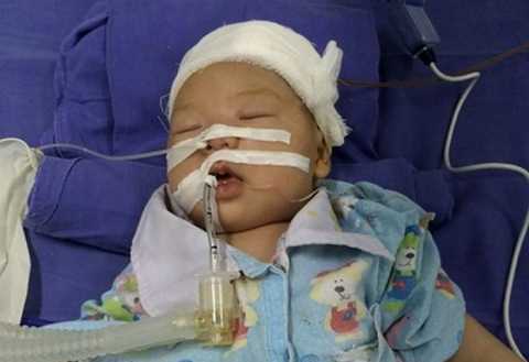 Dao quắm đâm xuyên sọ não trẻ 35 ngày tuổi