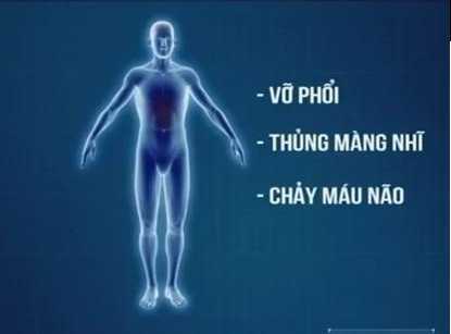 Áp lực từ vụ nổ ở Hà Đông có thể gây vỡ phổi, thủng màng nhĩ