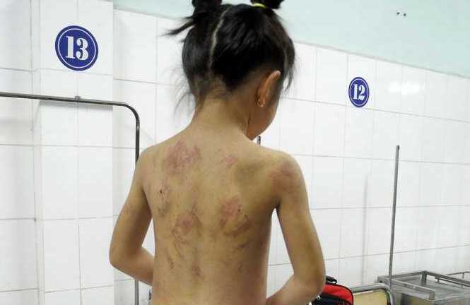 Bé 8 tuổi bị mẹ kế đánh bầm tím thân thể