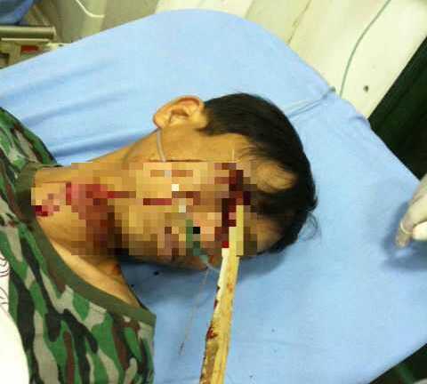 Ngã xe máy, người đàn ông bị cọc nhọn đâm xuyên mắt