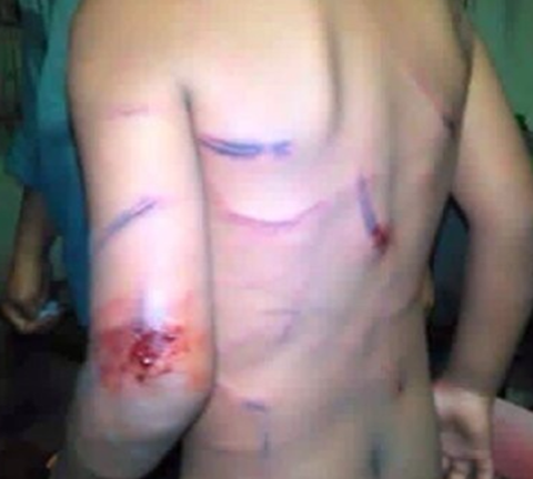 Bị cha dượng đánh như thú vật, bé 7 tuổi oằn mình chịu đòn roi