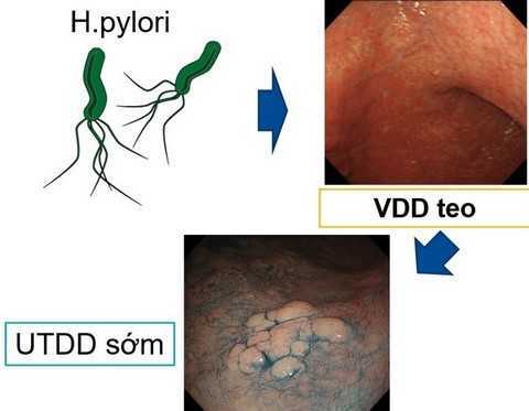 Diệt vi khuẩn Hp dạ dày, cần kết hợp nhiều loại thuốc