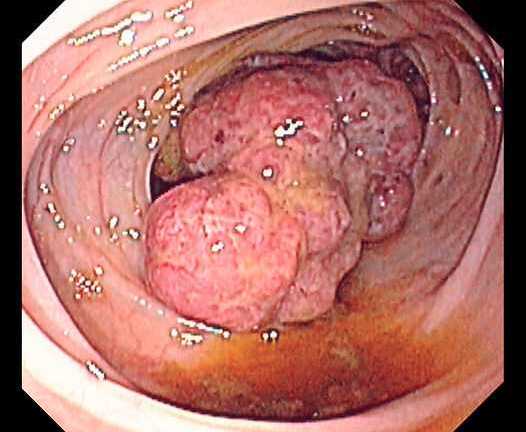 Phát hiện nguy cơ ung thư đại trực tràng