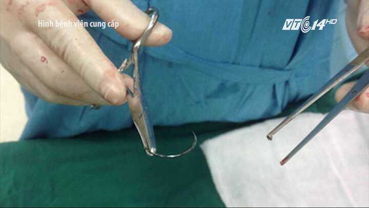 Bác sĩ để quên kim khâu phẫu thuật trong bụng bệnh nhân suốt 15 năm