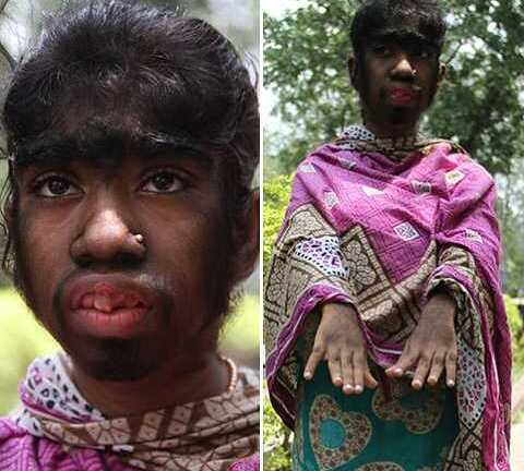 Kỳ lạ cô bé 'người sói' mọc lông khắp người