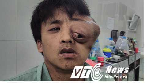 Xót xa người đàn ông mắt lòi ra khỏi tròng vì khối u khổng lồ