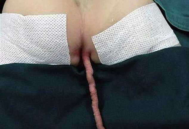 Sốc với hình ảnh cậu bé mọc đuôi 15cm sau lưng