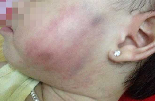 Nghi vấn bé gái 16 tháng tuổi bị tát bầm má: Phòng GD-ĐT Hà Đông vào cuộc