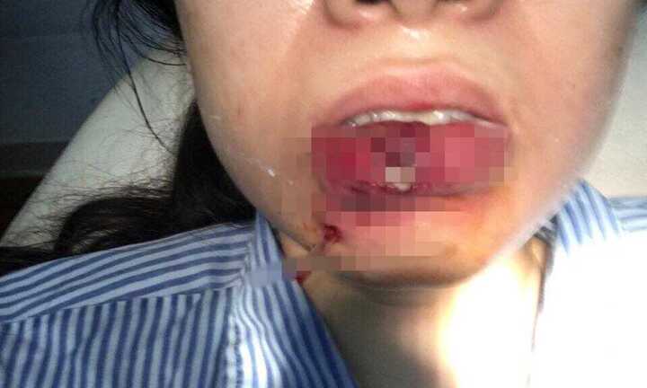 Bơm môi làm đẹp: Cô gái trẻ bị hoại tử, nguy cơ mất môi dưới